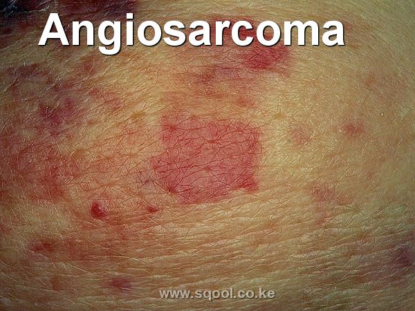Understanding Angiosarcoma: A Rare and Aggressive Form of Cancer