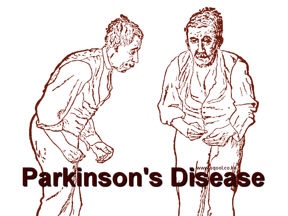 Parkinson's Disease: A Journey through Neurodegeneration