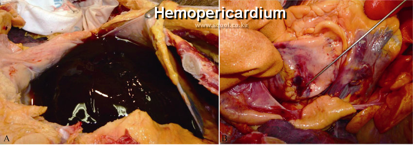 Hemopericardium: Causes, Symptoms, Diagnosis, Treatment, and Complications