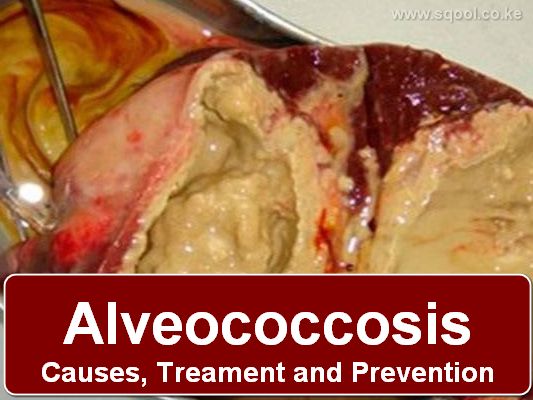 Alveococcosis: Causes, Treatment, and Prevention