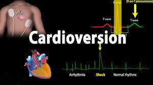Cardioversion: Restoring Heart Rhythm for Optimal Cardiovascular Health