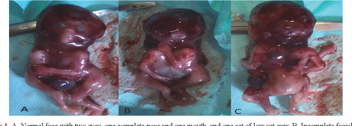 Cephalothoracopagus: Understanding a Rare Conjoined Twins Condition