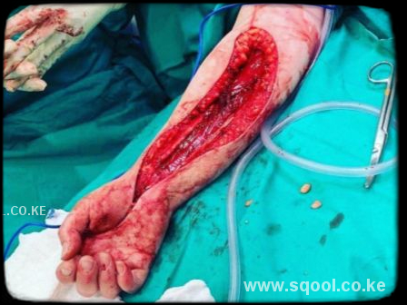 Compartment Syndrome: Causes, Symptoms, Diagnosis, Treatment, and Complications