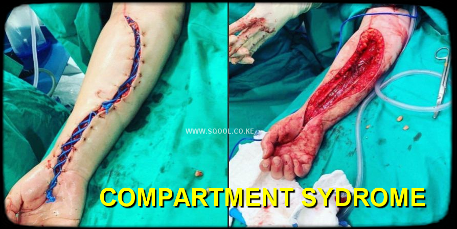 Compartment Syndrome: Causes, Symptoms, Diagnosis, Treatment, and Complications