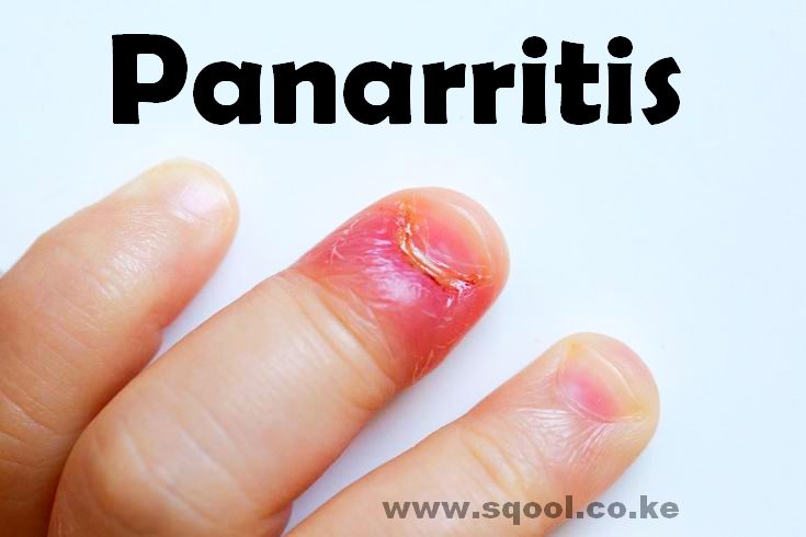 Panarritis: Causes, Treatment, and Prevention of Nail Infections