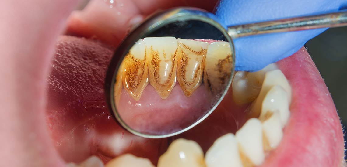 Periodontal Disease: Causes, Symptoms, and Treatment